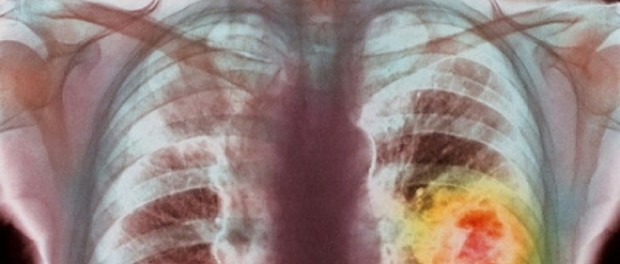 cancer pulmonar