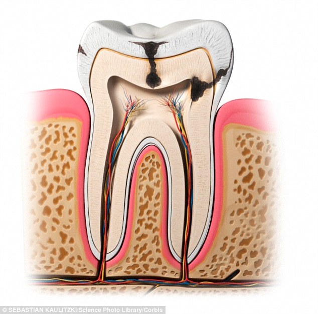 2EDCB89000000578-0-Dental_erosion_occurs_when_acid_dissolves_the_hard_tissues_of_th-a-17_1448655199182
