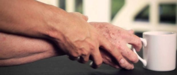 Parkinson (1)