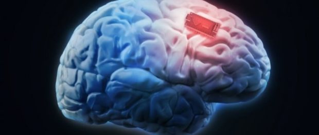 implant cerebral